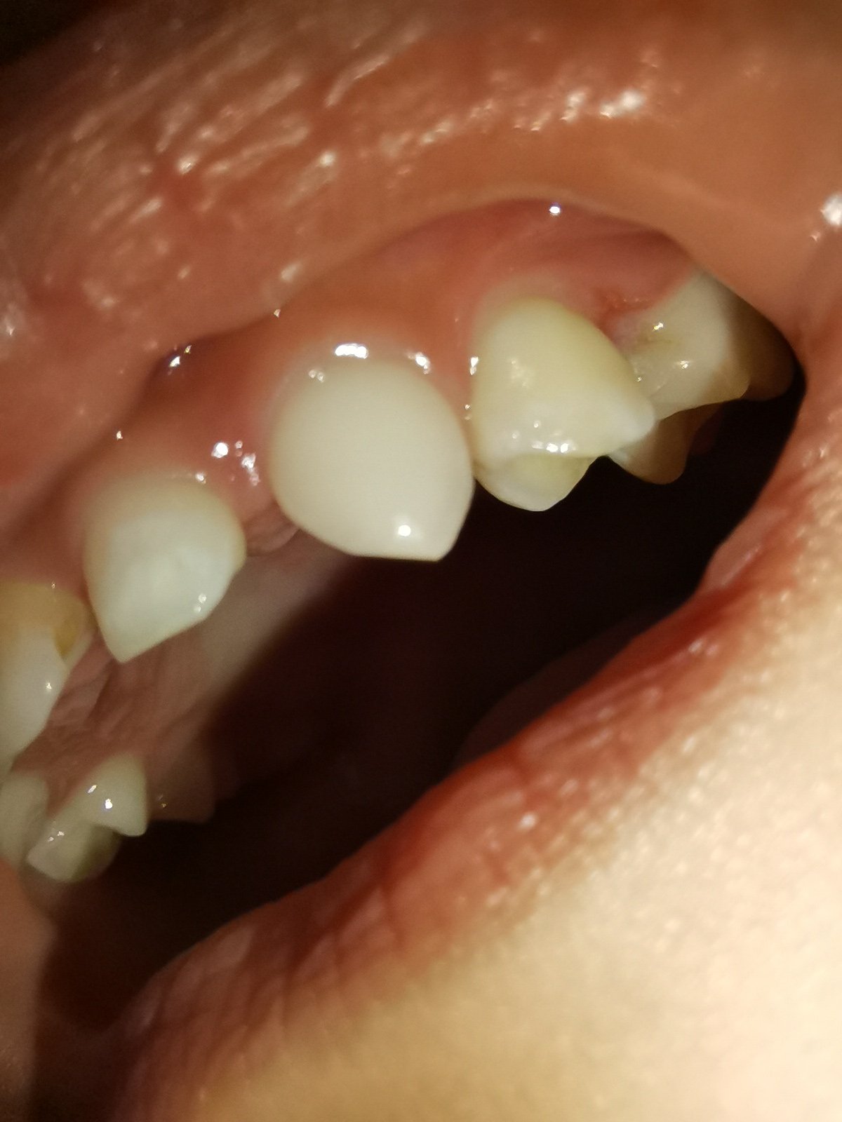 牙肉重建案例分享 - Dr. Implant 新竹光明牙醫診所
